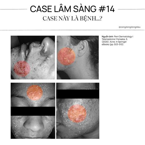 Bệnh viêm nang lông do vi khuẩn Gram Âm (Gram-negative folliculitis - GNF)