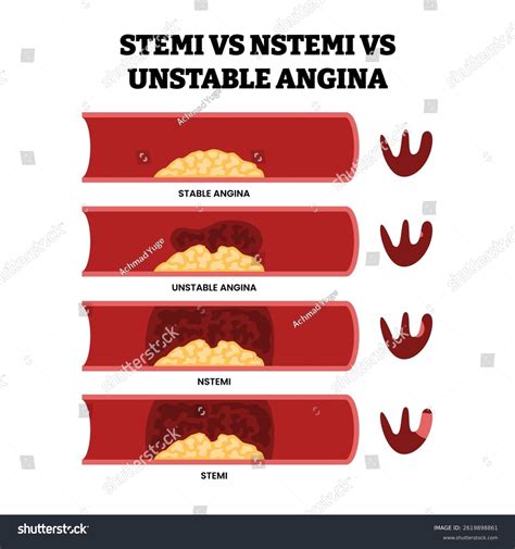 Different Types Stemi Vs Nstemi Stable Stock Vector (Royalty Free ...