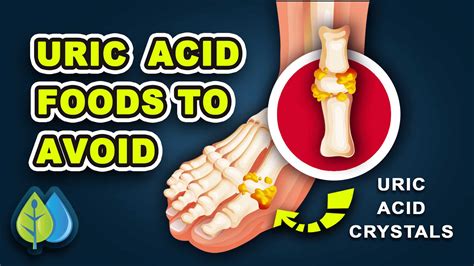 How To Quickly Remove Uric Acid Crystals From Your Body To Prevent Gout And Joint Pain ...
