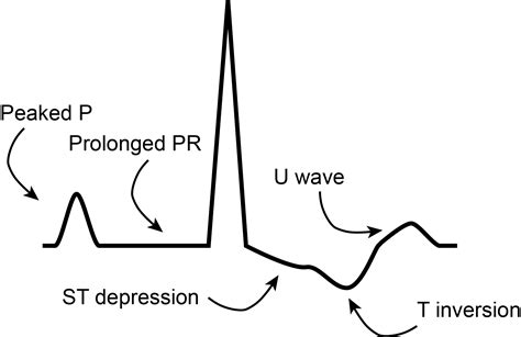 Potassium and Arrhythmias - Clinician Revision