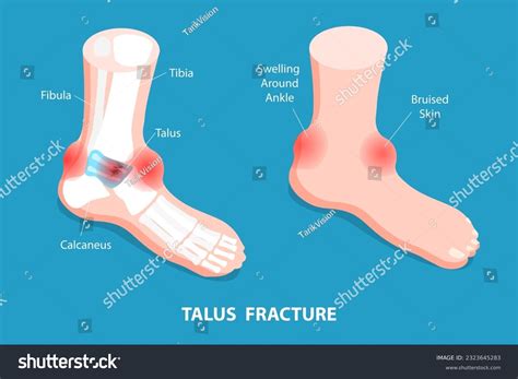 506 Talus Fracture Images, Stock Photos & Vectors | Shutterstock