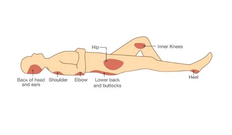 Bed Sore Surgery in Mumbai | Dr. Vinay Jacob