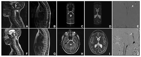 Cerebellar Tonsillar Descent Mimicking Chiari Malformation