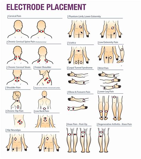 Tens Unit Electrode Placement Chart - Minimalist Chart Design