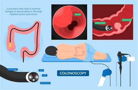 Colonoscopy Age