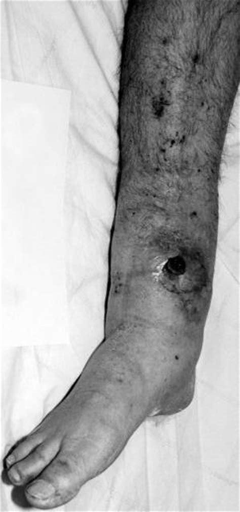 Infected Nonunion: Ankle Case 1 - Dr. Mark Brinker, Houston Orthopedic ...
