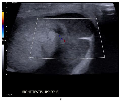 Testicular Choriocarcinoma Ultrasound