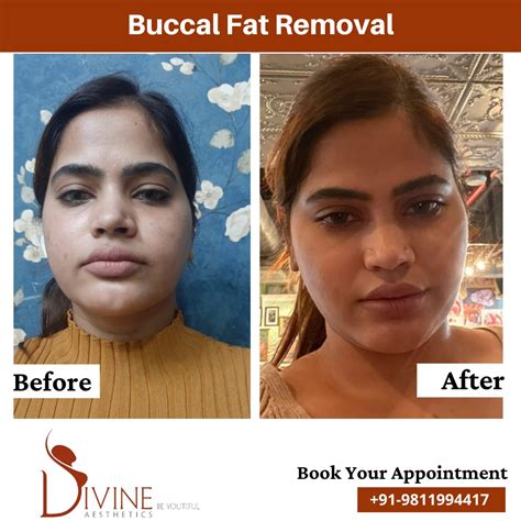 Procedure To Remove Fat From Face Hotsell | varsana.com