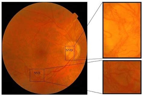 Proliferative Diabetic Retinopathy Diagnosis Using Varying-Scales ...
