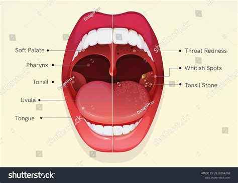 Healthy Tonsil Diagram