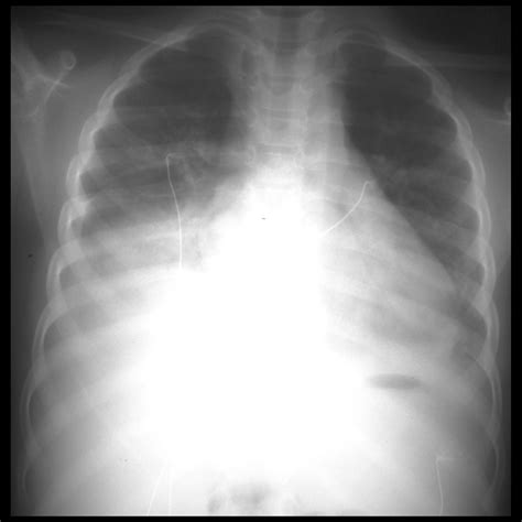 Pediatric Acute Chest Syndrome | Pediatric Radiology Reference Article | Pediatric Imaging ...