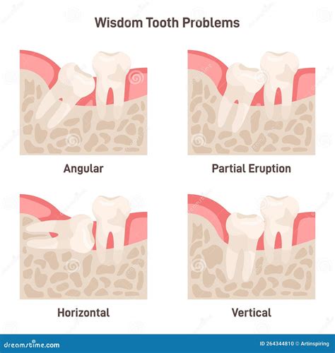 Wisdom Tooth Problems Set. Impaction, Wisdom Teeth Growing with Wrong Stock Vector ...