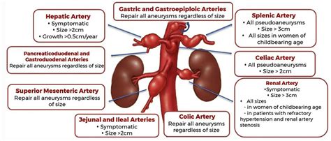 Visceral Arterial Aneurysm - Dr Karthikeyan Damodharan