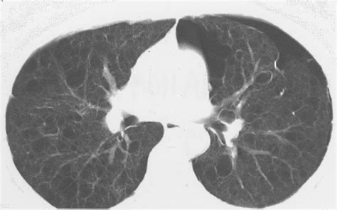 Multislice Helical CT of Focal and Diffuse Lung Disease Comprehensive ...