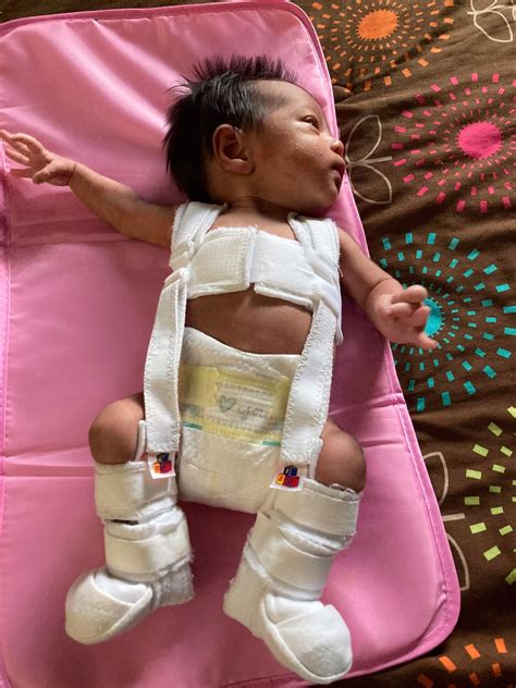 Selena's Hip Dysplasia Journey