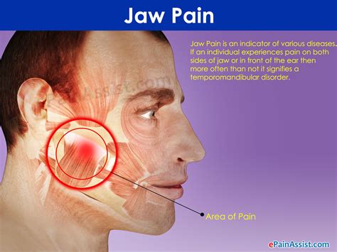 Pain In My Jaw When I Yawn , Trismus: Definition, Causes &Treatment – EHTN