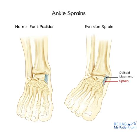 Ankle Sprains (Medial and Lateral) | Rehab My Patient