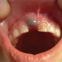 Image result for Exploding Mouth Cyst