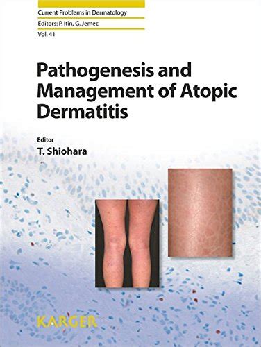 Buy Pathogenesis and Management of Atopic Dermatitis (Current Problems ...