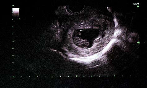 9 Week Baby Scan: What To Expect In This?