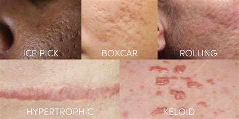 Everything You Need To Know About Acne Scarring - Dr Nerina Wilkinson ...