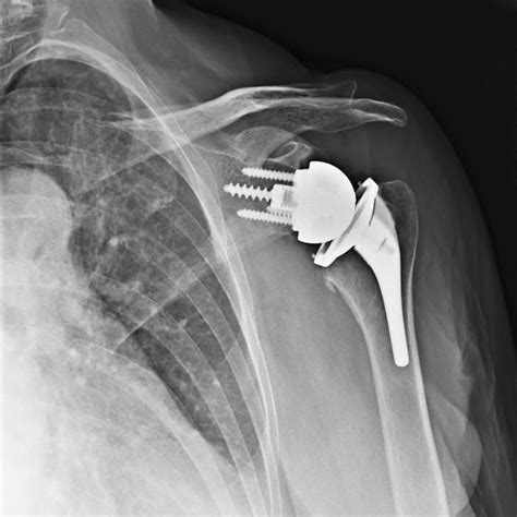 Precision Shoulder Replacement - Dr. Paul Kiritsis
