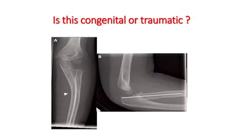 Pediatric Radial head dislocation | PPTX