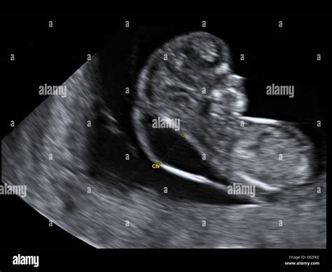 Nipt As Firstline Testing Ds Downs Syndrome Nt