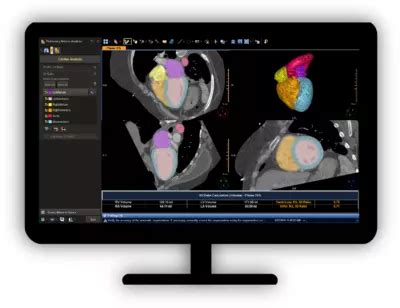 Philips - CT Pulmonary Artery Analysis