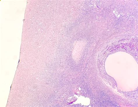 Pathology Outlines - Polycystic ovary disease