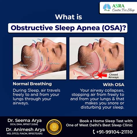Image result for Sleep Apnea Example
