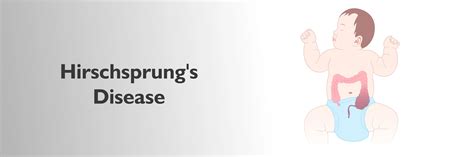 Enfermedad de Hirschsprung: síntomas, causas, diagnóstico y tratamiento