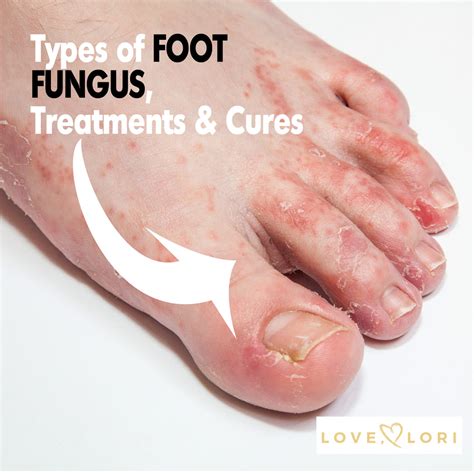Types of Foot Fungus — Athlete’s Foot Symptoms and Treatment – Love, Lori