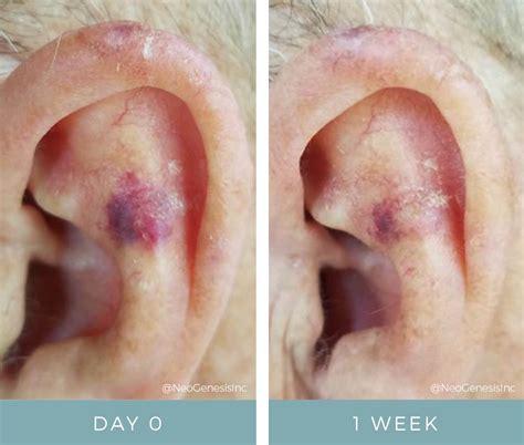 Topical Chemotherapy Side Effects Before + After NeoGenesis