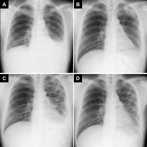 pulmonary consolidation treatment: white consolidation vs pleural effusion – NGOVJJ