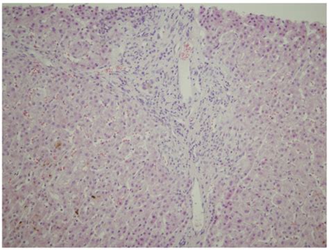 Intrahepatic Cholestasis of Pregnancy: A Case Study of the Rare Onset ...