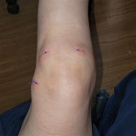 Knee arthroscopy stitches issue : r/medical