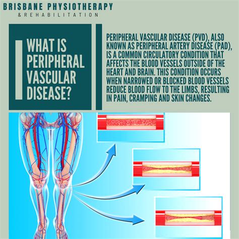 What is Peripheral Vascular Disease? - Brisbane Physiotherapy & Podiatry