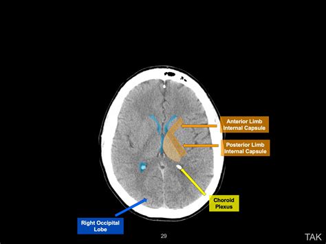 Brain Anatomy Ct Scan Annotated at Consuelo Villarreal blog