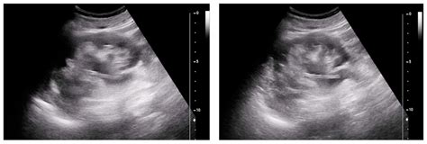 Complications Subsequent to Urinary Tract Stent Placement: An Overview Focusing on the Imaging ...