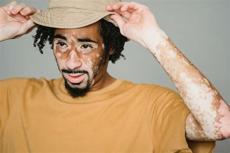Understanding Vitiligo: Symptoms, Types, Causes, and Treatments - what causes vitiligo