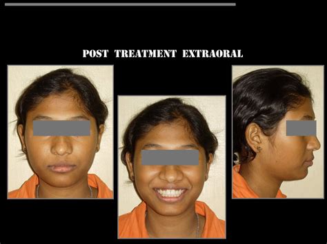 Dr. Ashok Surana | Smile Gallery