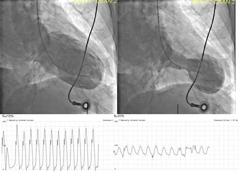 A case of bronchospasm-induced takotsubo cardiomyopathy during ...