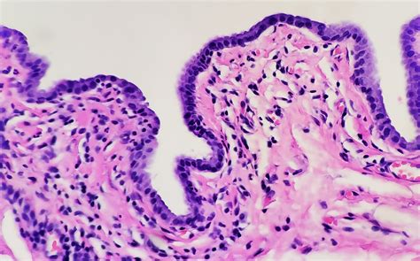 Gartners Duct Cyst Histology
