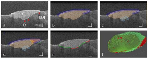 Analysis of Weighted Fraction of Length for Interfacial Gap in Cervical ...