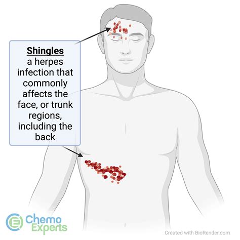 Herpes Zoster Nerve Chart Managing Neuropathic Pain: New Approaches