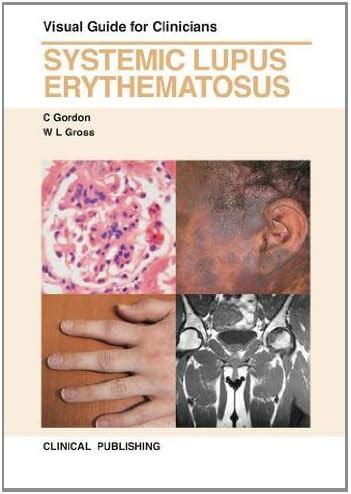 Buy Systemic Lupus Erythematosus: Visual Guide for Clinicians Book ...