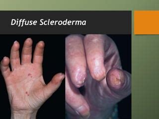 Image result for Diffuse Scleroderma