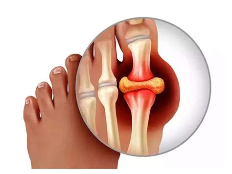 How to check Uric acid : शरीर में इस एसिड की मात्रा बढ़ने से खराब होने ...