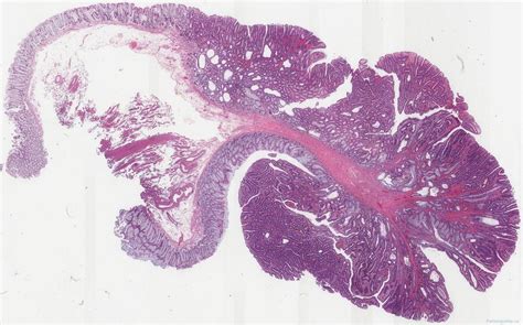 Tubulovillous adenoma of the colon | Atlas of Pathology